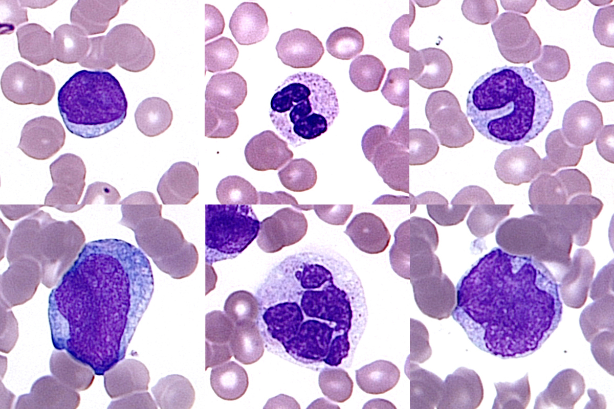 Representative cells in peripheral blood: a normal sized blast, mature granulocyte and mature monocyte (top panel L-R). In comparison giant blast, granulocyte, and monocyte (lower panel L-R) likely from the tetraploid clone.